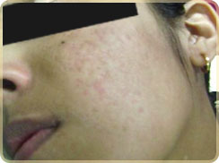 Laser Skin treatments in kerala